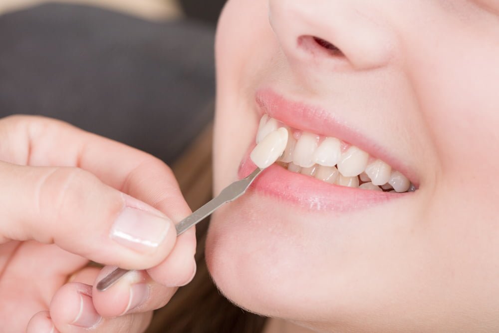 Răng sứ veneer là gì? Ưu – nhược điểm và quy trình thực hiện | Trung tâm Y  tế Hòa Vang