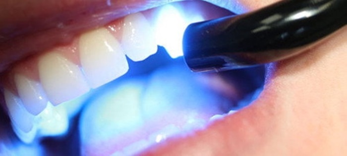 Trám răng laser tech để làm đẹp và bảo vệ răng hiệu quả - Nha khoa Quốc Tế  Việt Pháp : Nha khoa Quốc Tế Việt Pháp