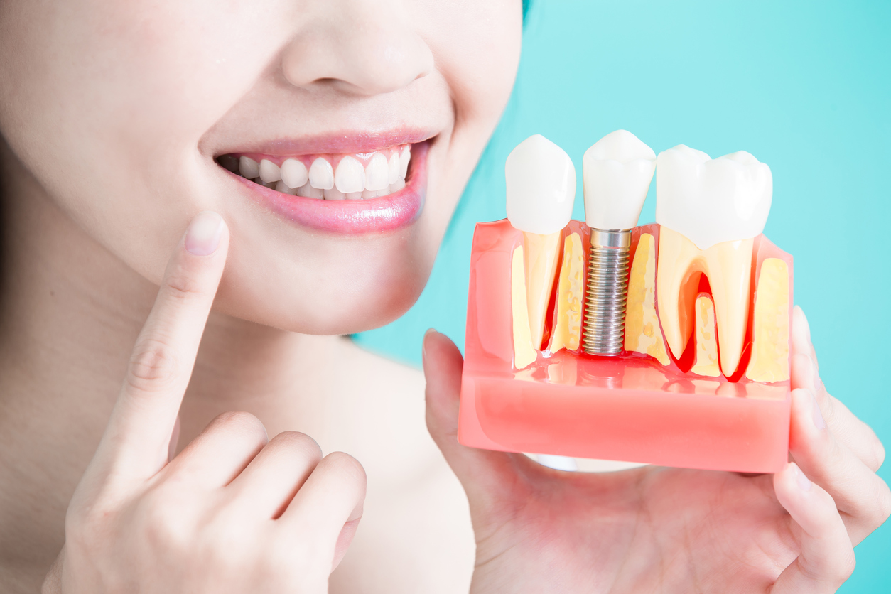Phục hình răng sứ trên implant và một số điều cần lưu ý