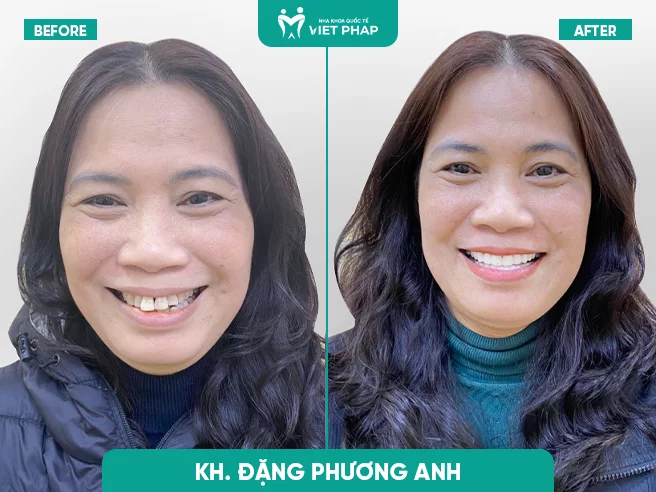 Image Ngô Thanh Huyền image beautiful image beautiful image beautiful image beautiful image beautiful image beautiful image beautiful image beautiful image beautiful image beautiful - What is Dental Crowning & Is It Good? Prices Starting from ...