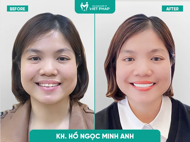 boc rang su nha khoa quoc te viet phap 3