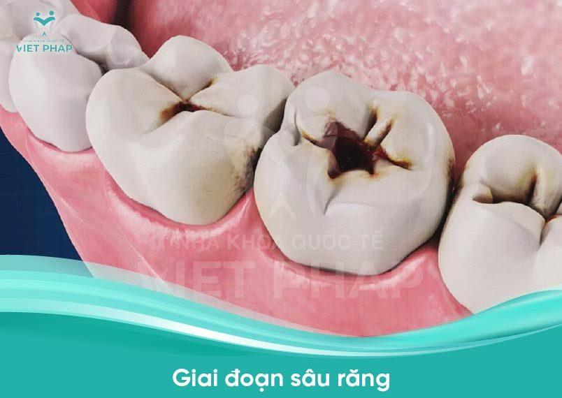 cac giai doan sau rang 3 Giai đoạn sâu răng