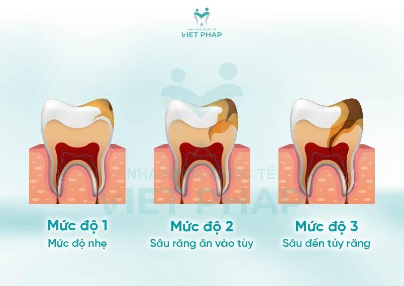 cac giai doan sau rang 4 Các mức độ sâu răng