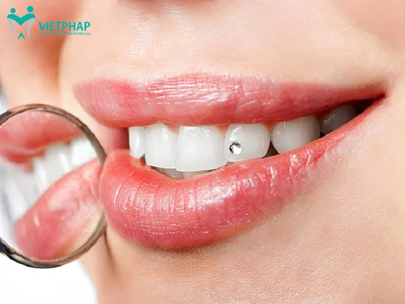 ĐÍNH ĐÁ RĂNG TẠI HÀ NỘI VỚI VIÊN ĐÁ LẤP LÁNH TRÊN RĂNG SỨ