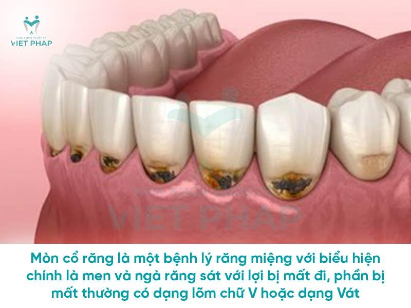 Mòn cổ răng là một bệnh lý răng miệng với biểu hiện chính là men và ngà răng sát với lợi bị mất đi