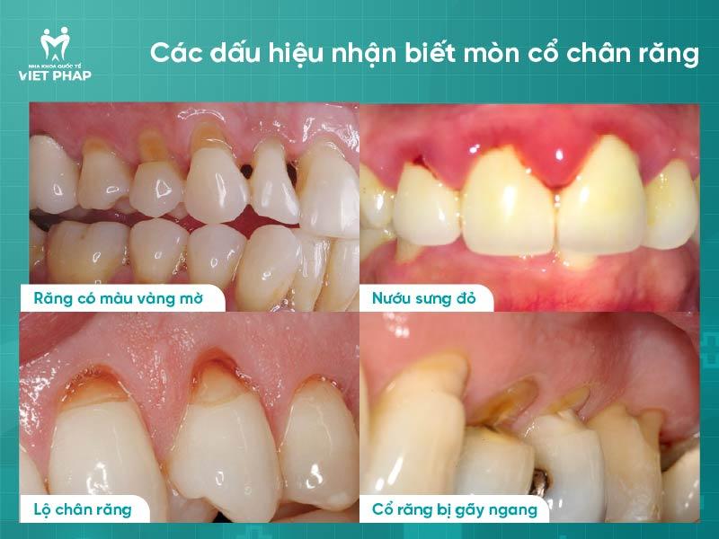 Dâu hiệu nhận biết mòn cổ chân răng là lộ chân răng, nướu sưng đỏ