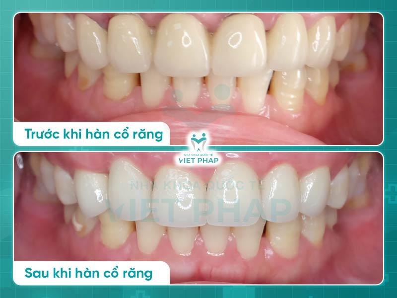 Hình ảnh trước và sau khi hàn cổ răng