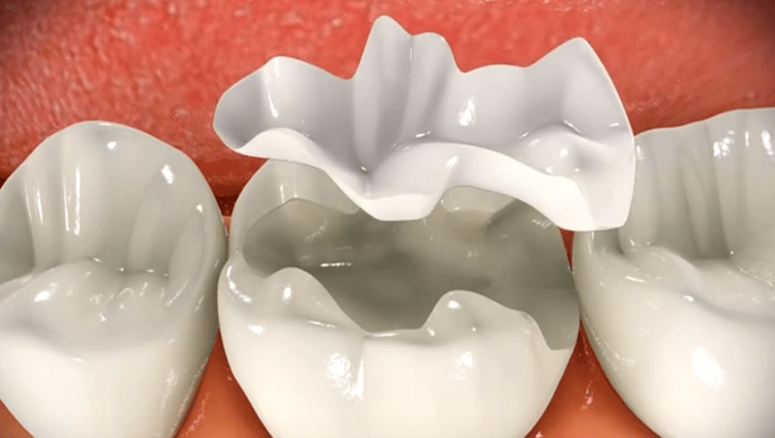 Hàn răng bằng composite