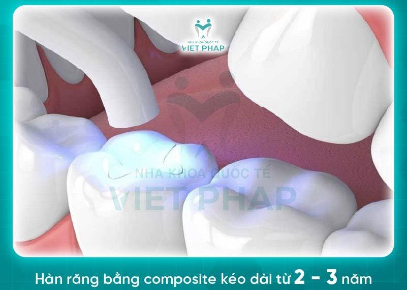 han rang bang composite 4 1 Hàn răng composite kéo dài từ 2 - 3 năm