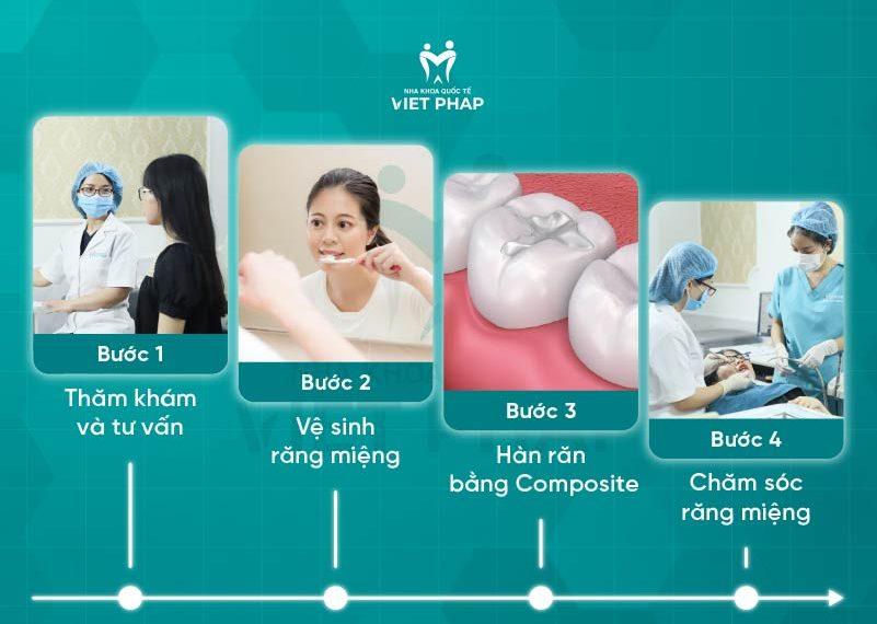 han rang bang composite 5 Quy trình hàn răng bằng composite