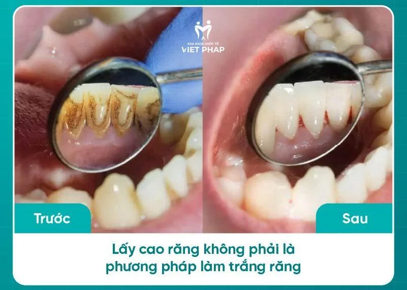 Lấy cao răng làm trắng răng: Bí quyết để răng khỏe đẹp và trắng sáng