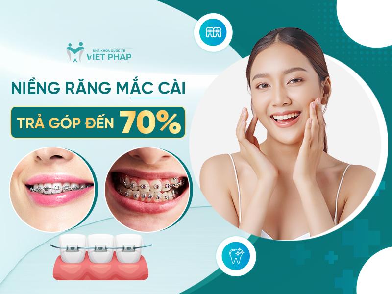 Niềng răng mắc cài trả góp lên đến 70%