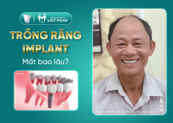 [Review] Trồng răng implant mất 1 – 3 tháng? 14 lưu ý “sống còn” cần biết