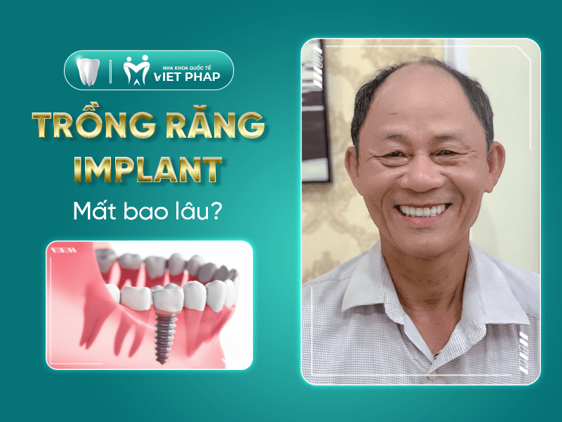 trong rang implant mat bao lau