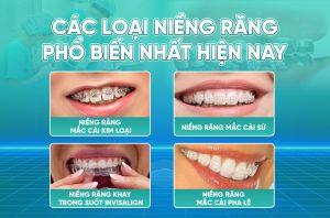 4 loai nieng rang 2 1 Các loại niềng răng phổ biến hiện nay