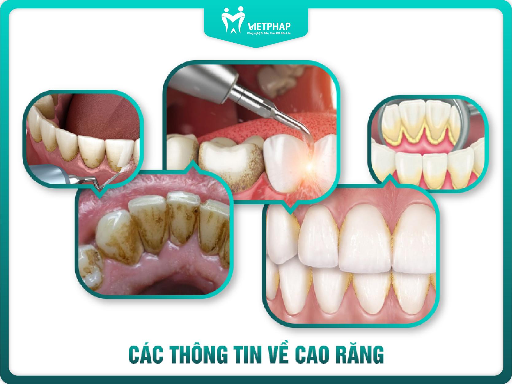 Lấy cao răng là gì?