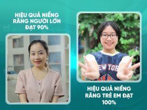 nieng rang nguoi lon 3 So sánh niềng răng người lớn và niềng răng trẻ em