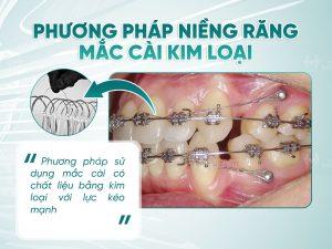 nieng rang nguoi lon 4 Niềng răng mắc cài kim loại