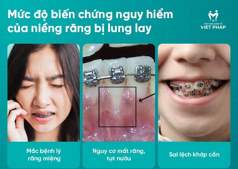 Mức độ biến chứng nguy hiểm của niềng răng bị lung lay