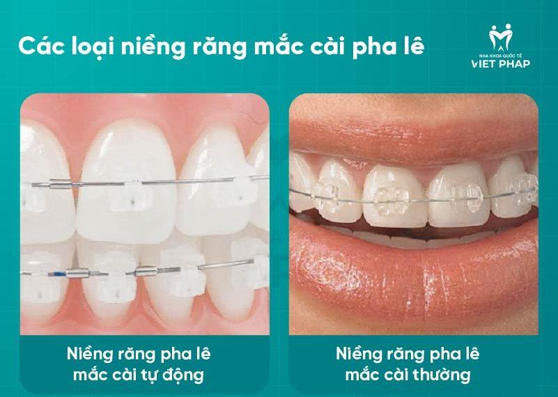 nieng rang pha le 2 Hai loại niềng răng mắc cài pha lê