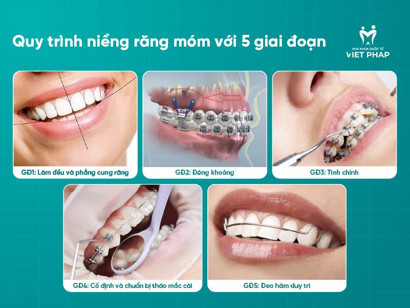 Quy trình niềng răng móm với 5 giai đoạn