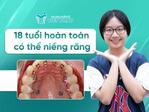 18 tuổi có niềng răng được không