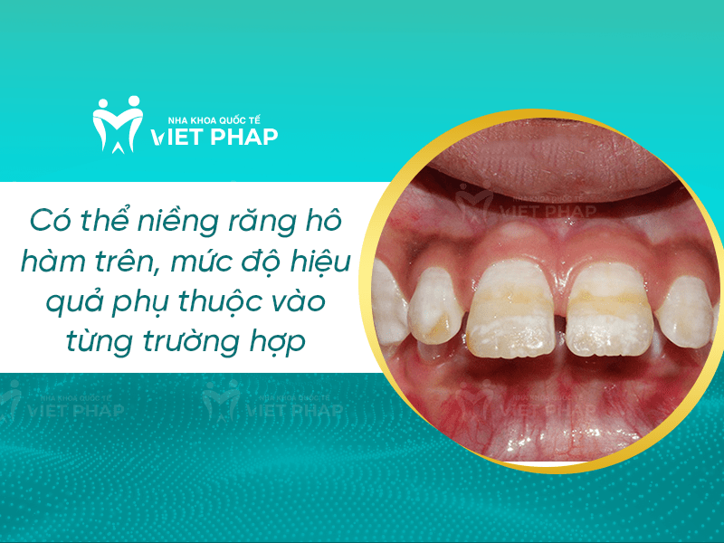 2 2 Niềng răng hô hàm trên được không?