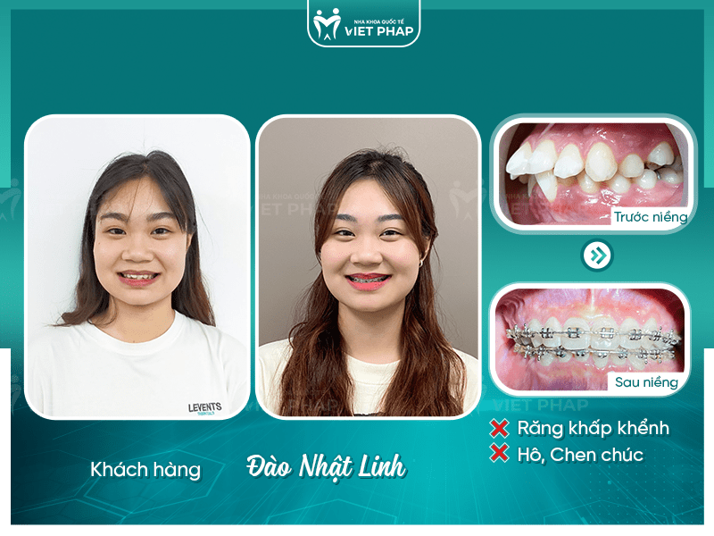 3 2 Hình ảnh khách hàng Đào Nhật Linh trước và sau khi niềng răng hô hàm trên