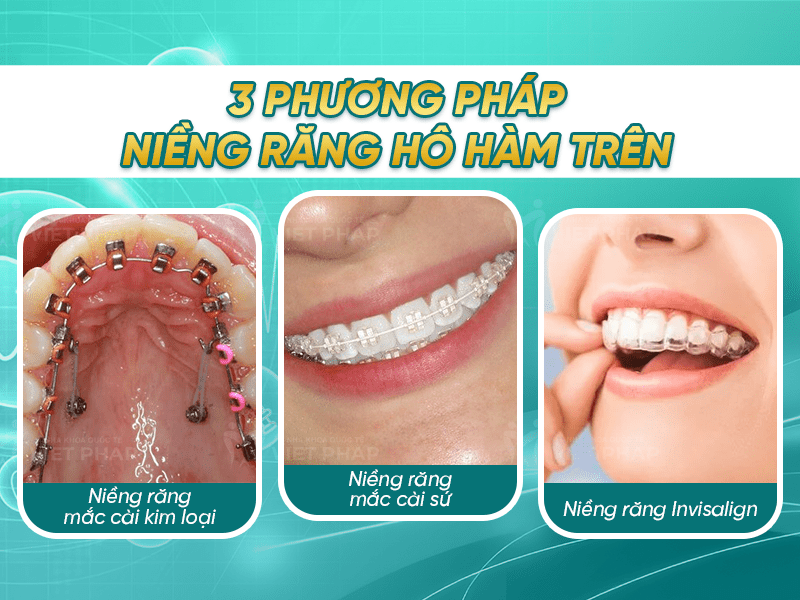 4 2 3 phương pháp niềng răng hô hàm trên