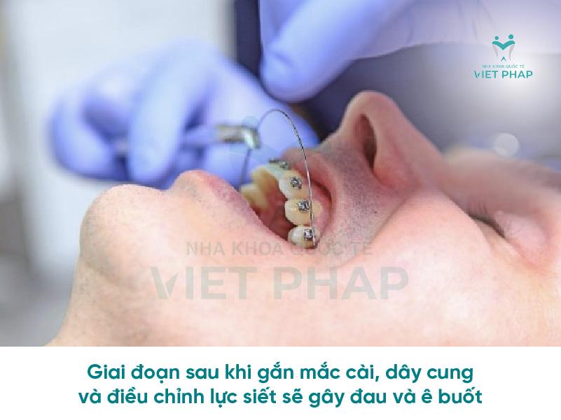 Quá trình niềng răng có đau không?