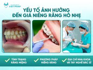 Yếu tố ảnh hưởng đến giá niềng răng hô nhẹ 