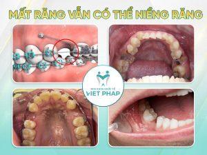 Mất răng vẫn có thể niềng răng