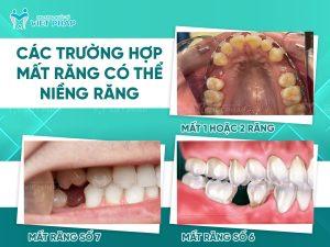 Các trường hợp mất răng có thể niềng răng 