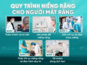 Quy trình niềng răng cho người mất răng gồm 5 bước