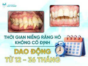 Thời gian niềng răng hô không cố định, dao động từ 12 - 36 tháng