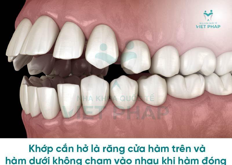 Khớp cắn hở là răng cửa hàm trên và hàm dưới không chạm vào nhau khi hàm đóng