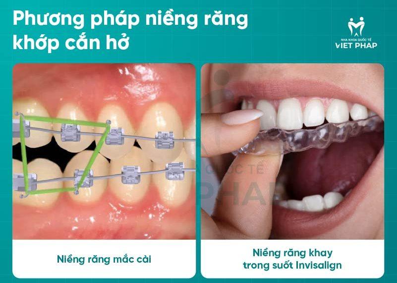 Phương pháp niềng răng khớp cắn hở