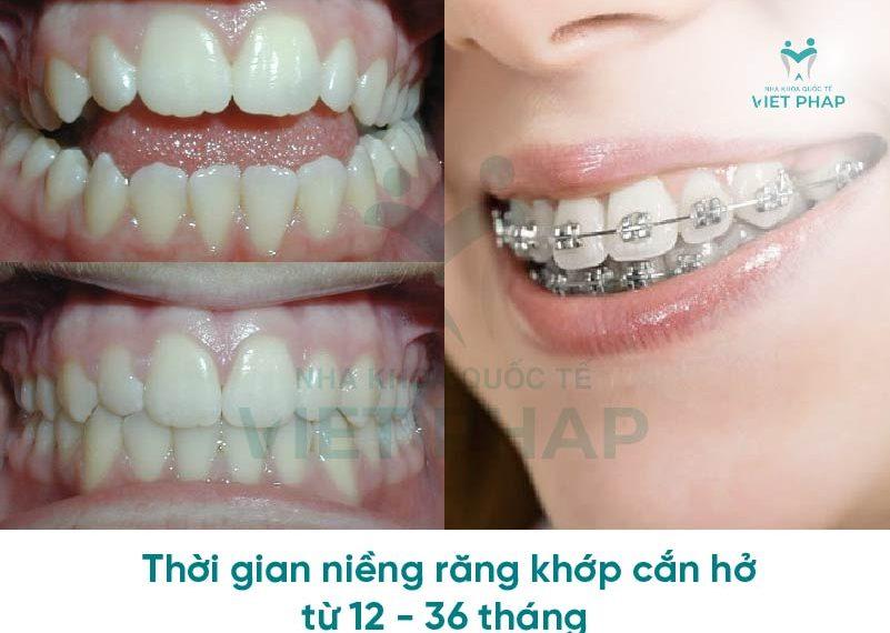 Thời gian niềng răng khớp cắn hở từ 12 - 36 tháng