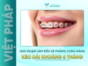 Giai đoạn làm đều và phẳng cung răng