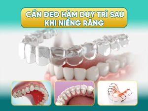 Cần đeo hàm duy trì sau khi niềng răng