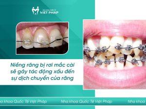Niềng răng bị rơi mắc cài sẽ ảnh hưởng đến quá trình chỉnh nha