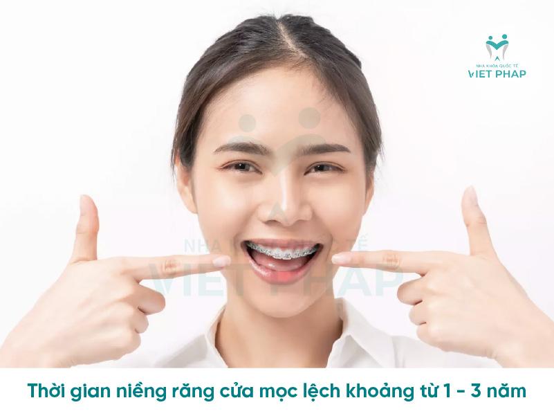 nieng rang cua moc lech mat bao lau 1 Thời gian niềng răng cửa mọc lệch khoảng từ 1 - 3 năm