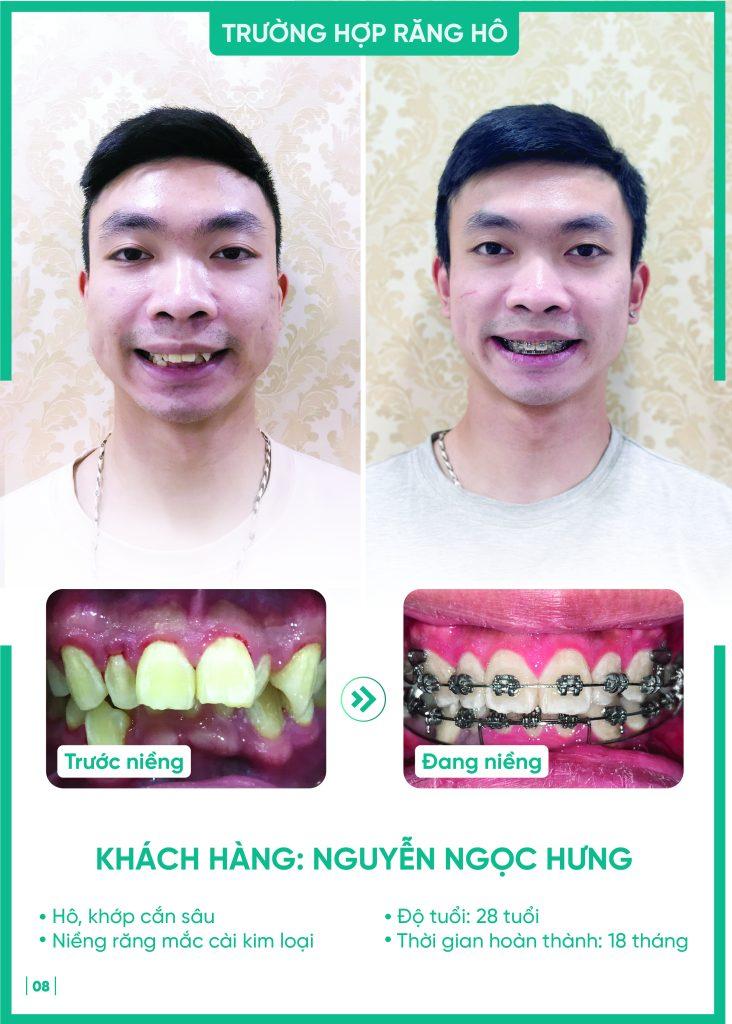 nieng rang ho ham tren nguyen ngoc hung Khách hàng Nguyễn Ngọc Hưng