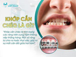 nieng rang khop can cheo 1 Khớp cắn chéo là gì