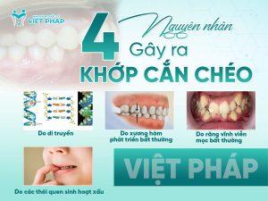 nieng rang khop can cheo 2 Nguyên nhân gây ra khớp cắn chéo