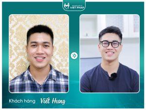 nieng rang khop can cheo 6 Viết Hưng trước và sau khi niềng răng