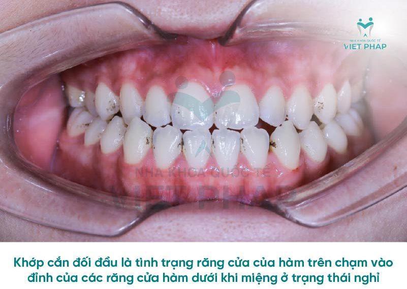nieng rang khop can doi dau 1 Khớp cắn đối đầu là gì?