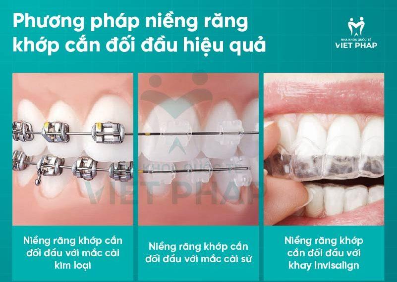 nieng rang khop can doi dau 3 Phương pháp niềng răng khớp cắn đối đầu