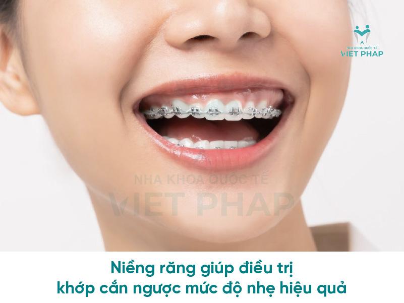 Niềng răng điều trị hiệu quả khớp cắn ngược mức độ nhẹ