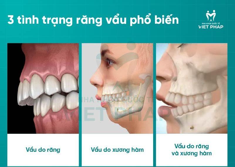nieng rang vau 1 tình trạng răng vẩu phổ biến
